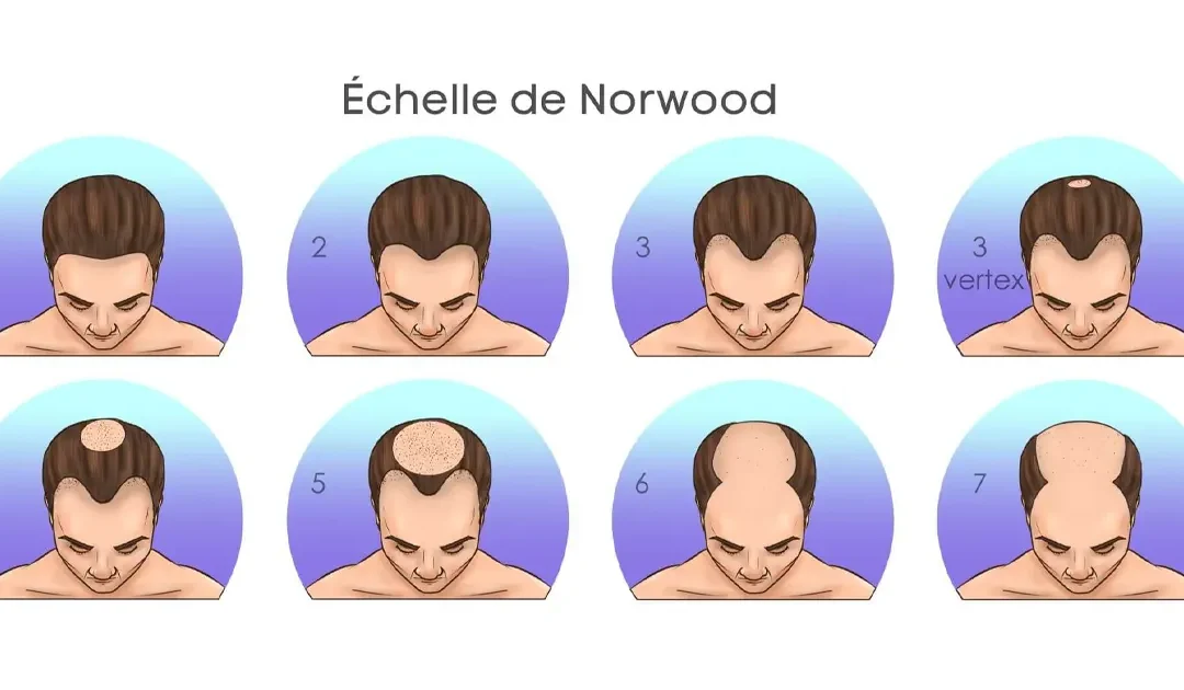 Échelle de Norwood-Hamilton