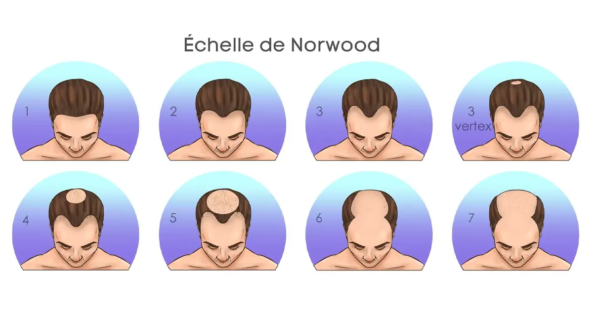 Echelle de Norwood : quelle est son utilité pour une greffe de cheveux ?